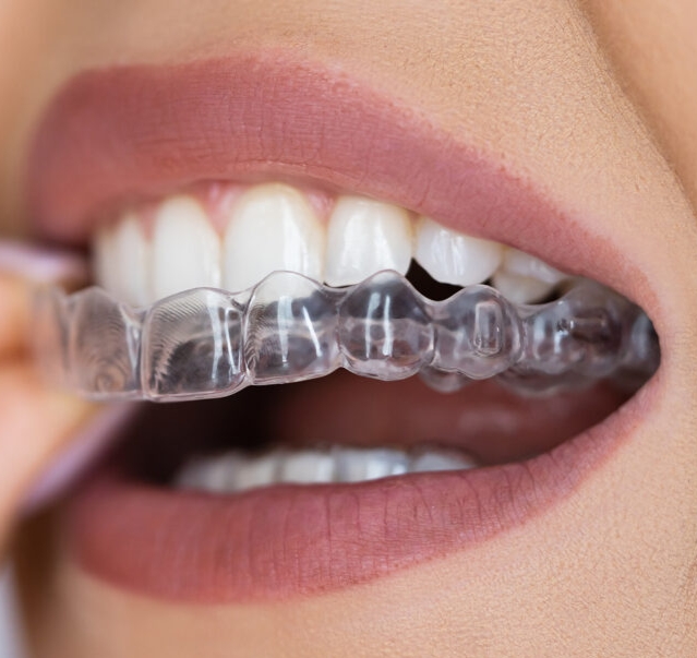 CLEAR ALIGNERS
