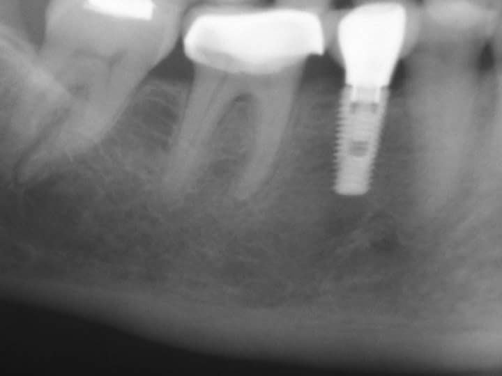 dental implants
