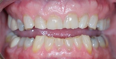 How To Fix Worn Down Teeth?
