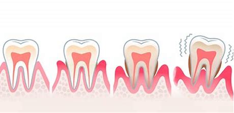 tooth mobility

