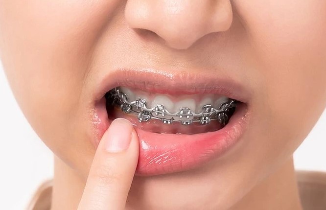 How To Make Your Teeth Stop Hurting From Braces?
