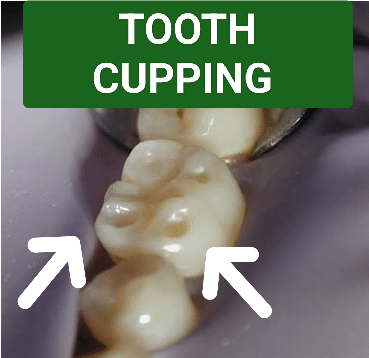 TOOTH CUPPING