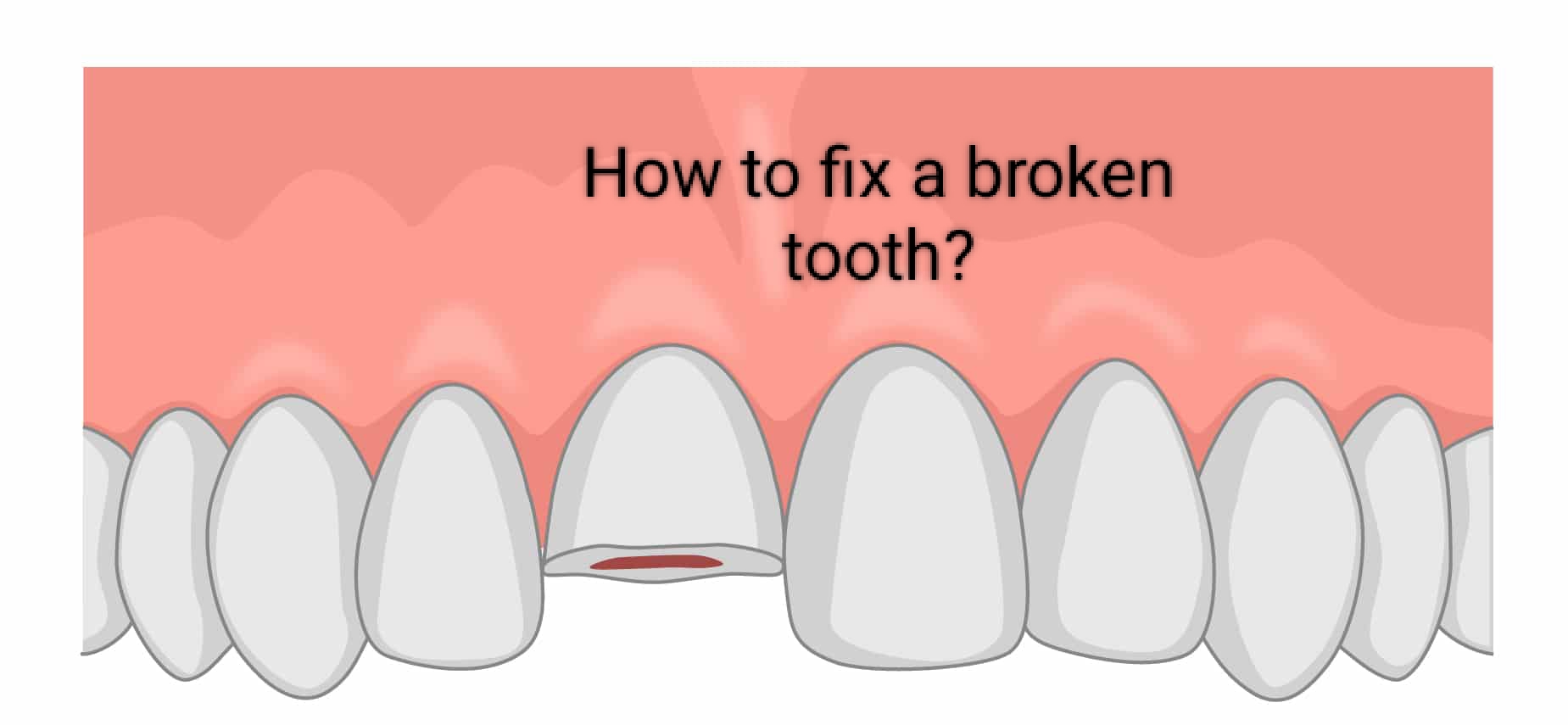 how to fix a broken tooth