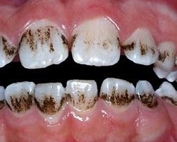 Tooth stains