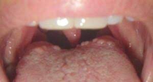 bumps on the back of the tongue