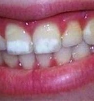 intrinsic stains on teeth
