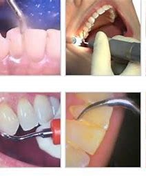 dental cleaning
