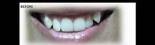 vampire teeth
