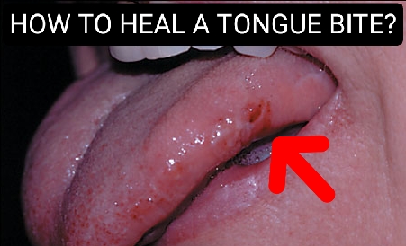 HOW TO HEAL A TONGUE BITE