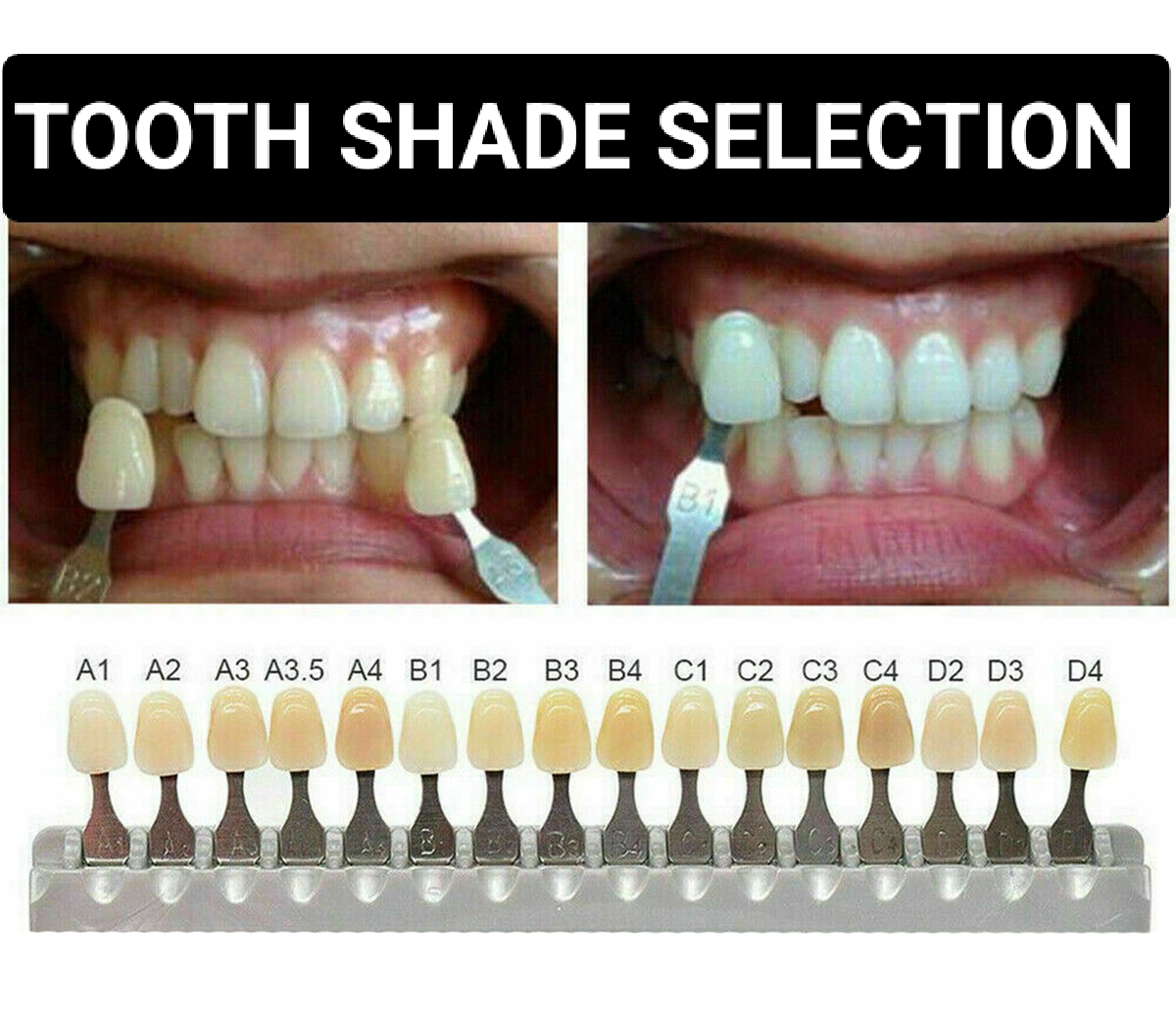 TOOTH SHADE